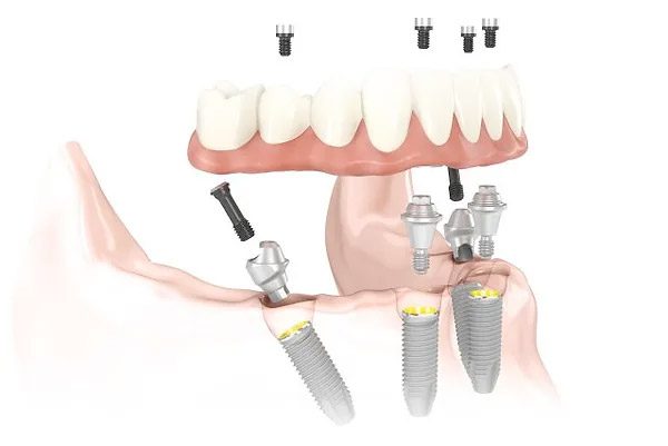 All-On-4 Implants